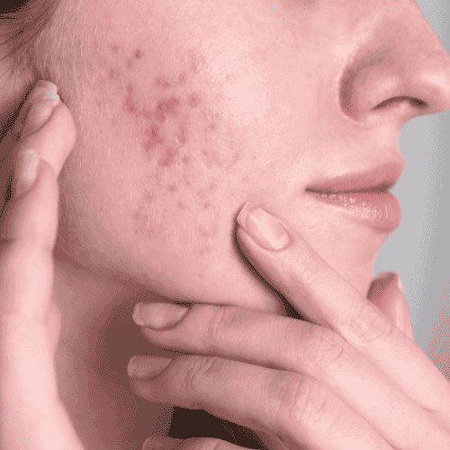 Acne skincare concern - ILLUME SKIN