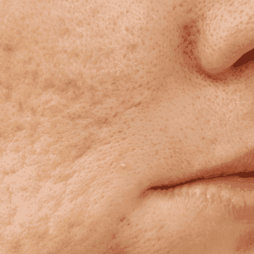 Large Pores & Acne Scars skincare concern - ILLUME SKIN