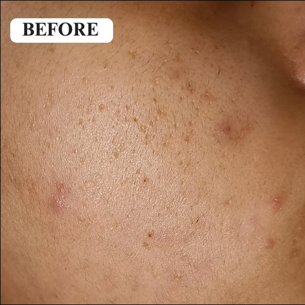 Before - PIGMENTATION AND DARK SPOTS