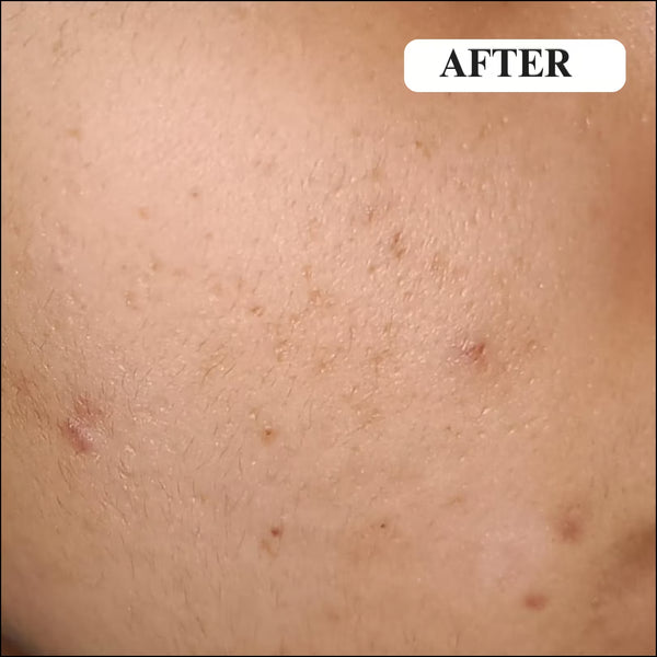 After - PIGMENTATION AND DARK SPOTS