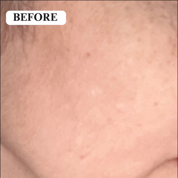 Before - Pigmentation and fine lines