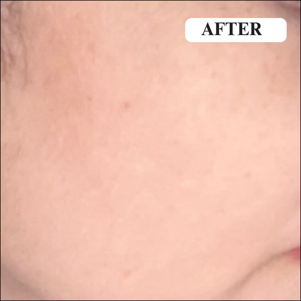 After - Pigmentation and fine lines