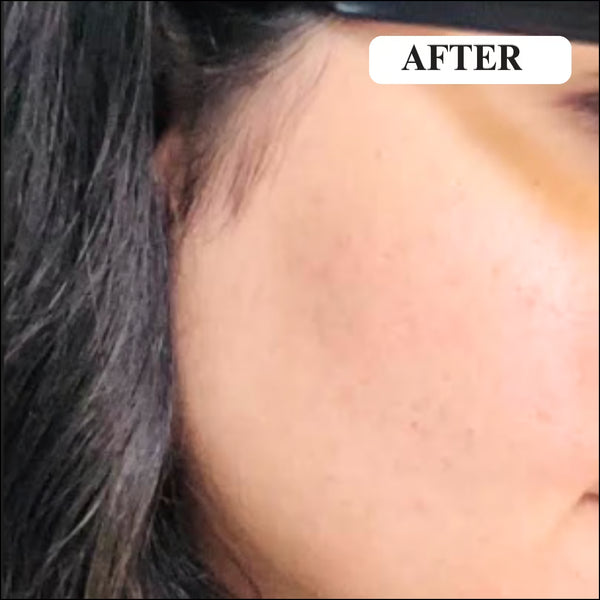 After - Dull and Inflamed Skin