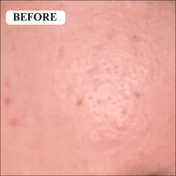 Before - Open pores and dark spots