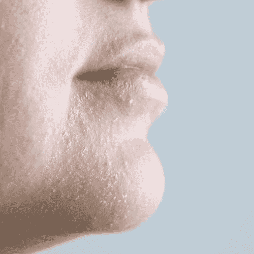 Dryness & Barrier Damage skincare concern - ILLUME SKIN