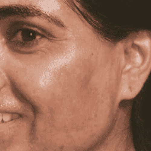 pigmentation and uneven skintone