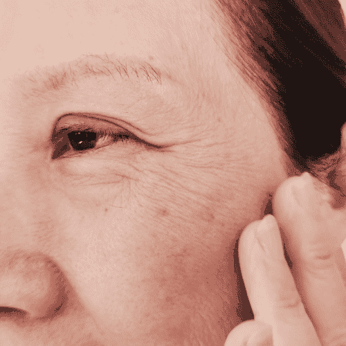 Fine lines and wrinkles